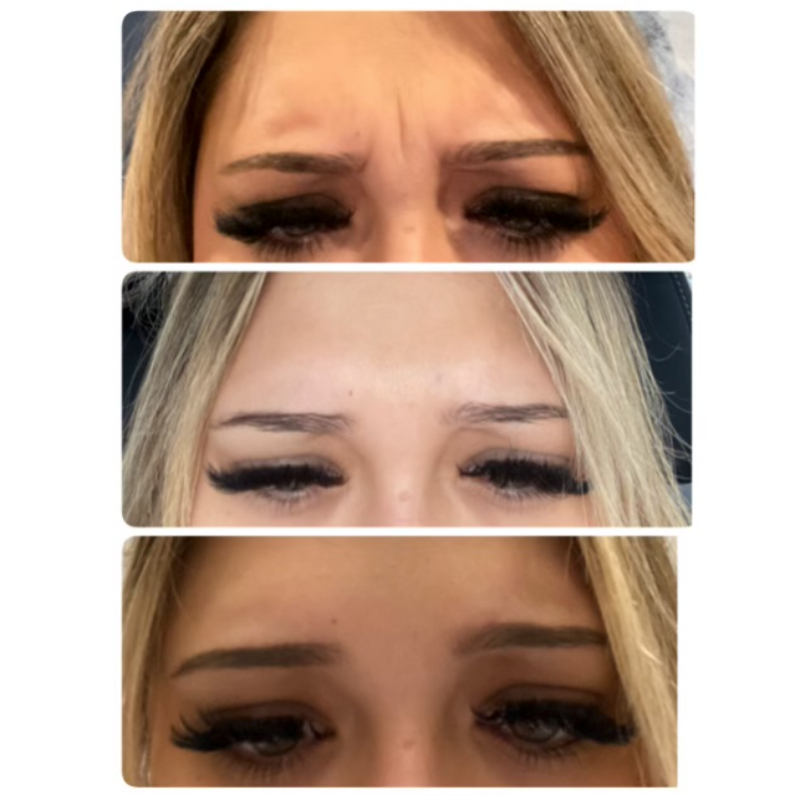 botox frown line before and after