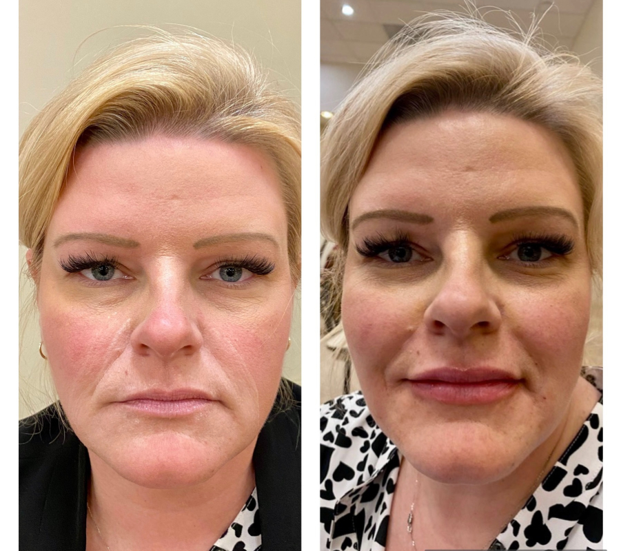 before and after cheek and lip fillers at med spa