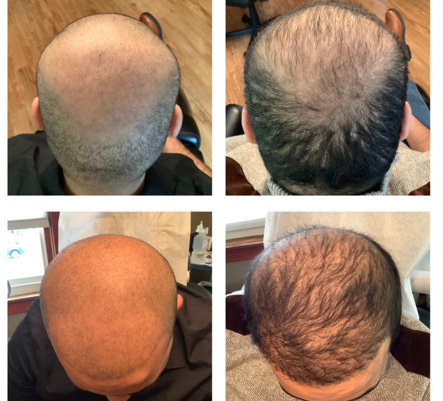 before and after professional balding treatment at lancaster med spa