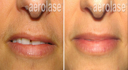 before and after photo of mustache and upper lip dark hair laser hair removal