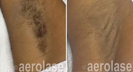 before and after photo of arm pit laser hair removal