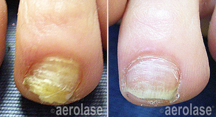 before and after laser treatment for toe nail fungus