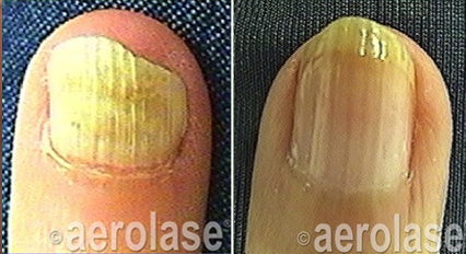 before and after laser treatment for nail fungus