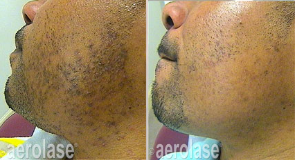 before and after laser hair removal on black man's face