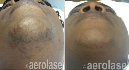 treating bumps and ingrown hairs with laser hair removal on poc