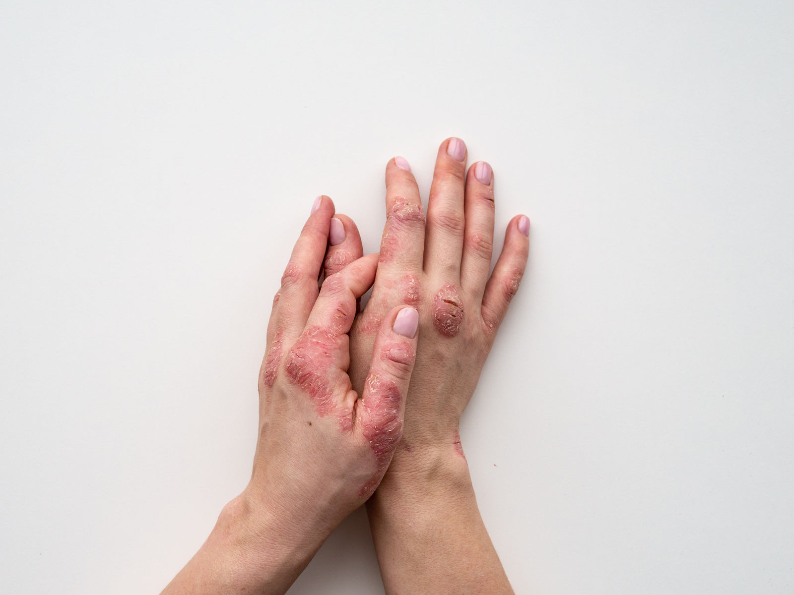 hands with severe psoriasis