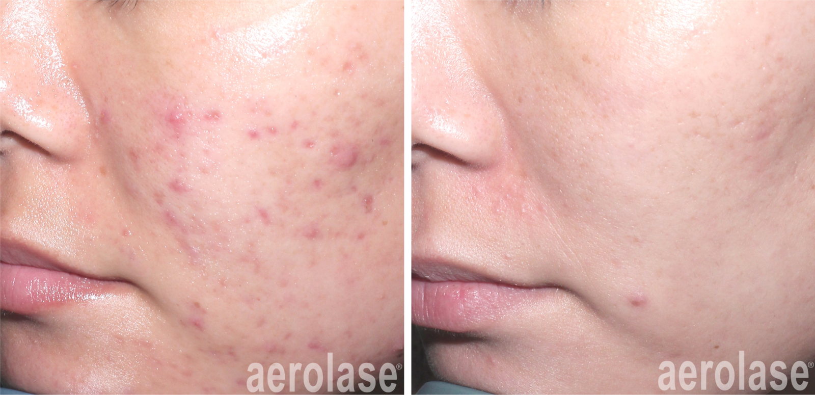 before and after laser acne treatment on cheeks