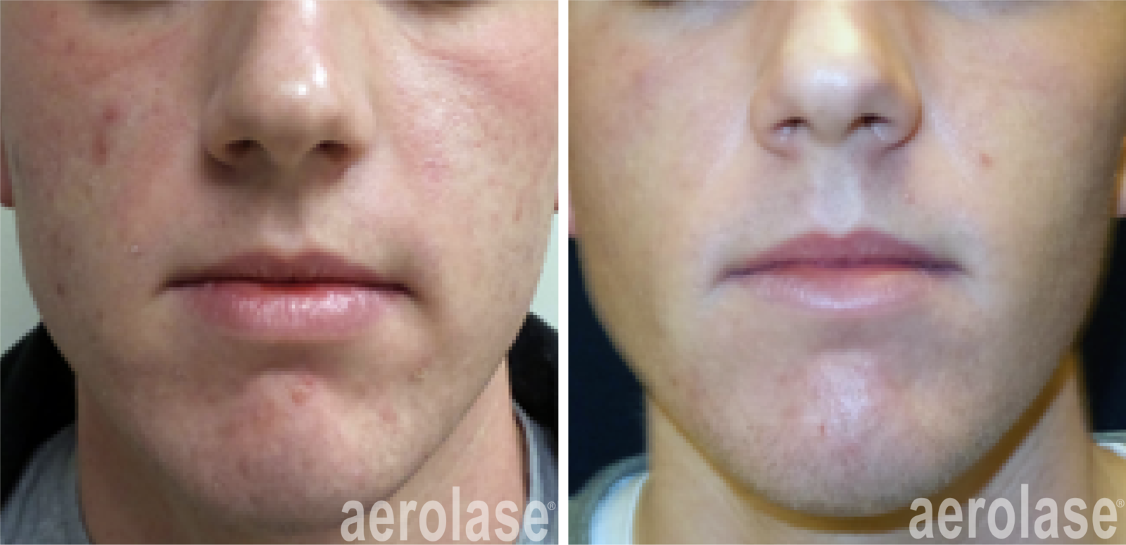 before and after laser acne treatment
