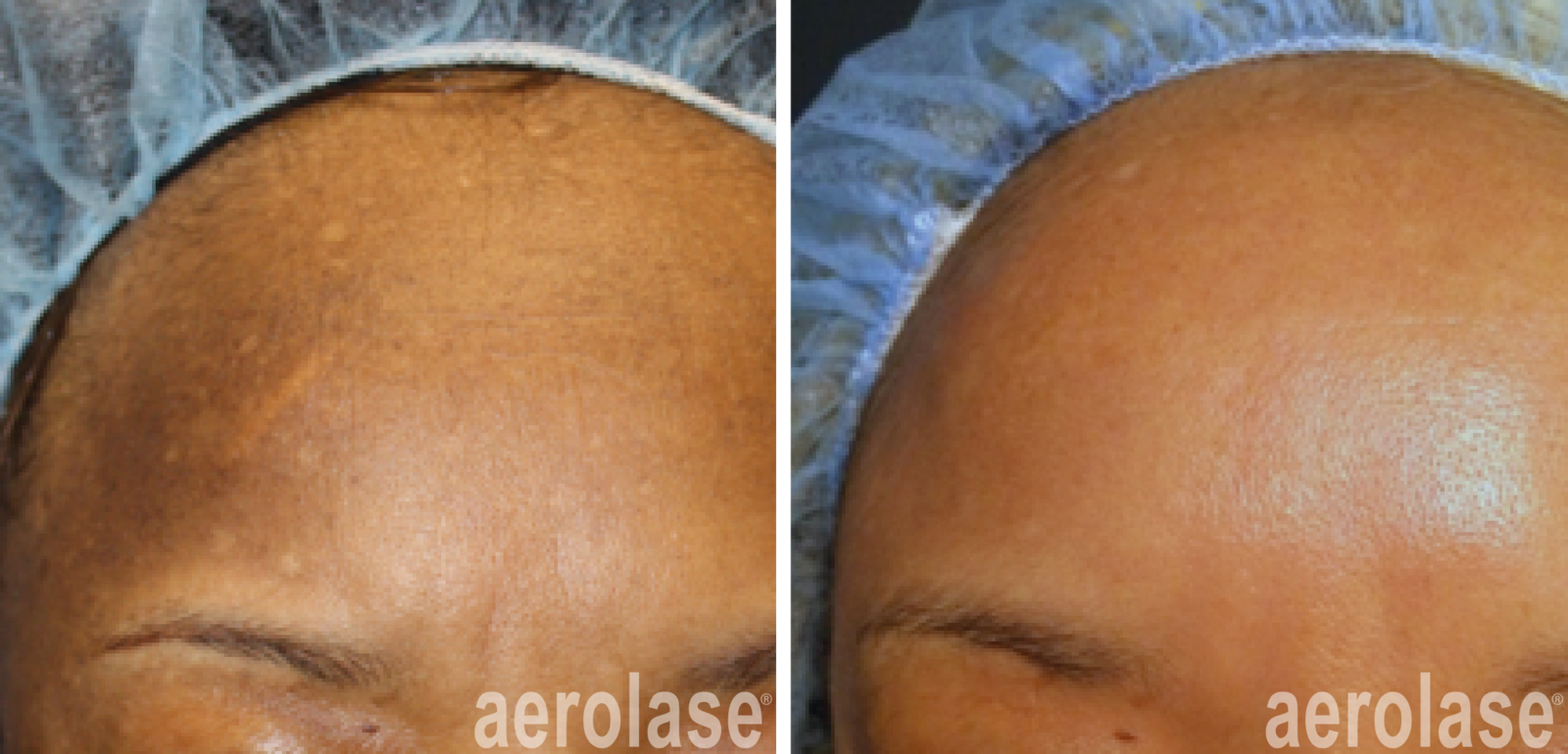 before and after laser melasma treatment