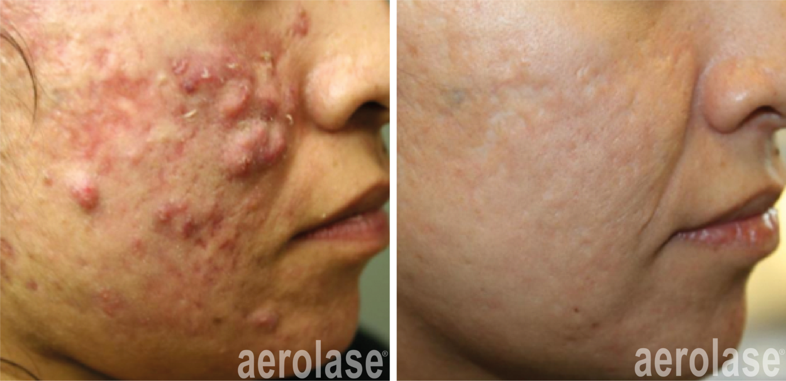 before and after laser acne treatment severe