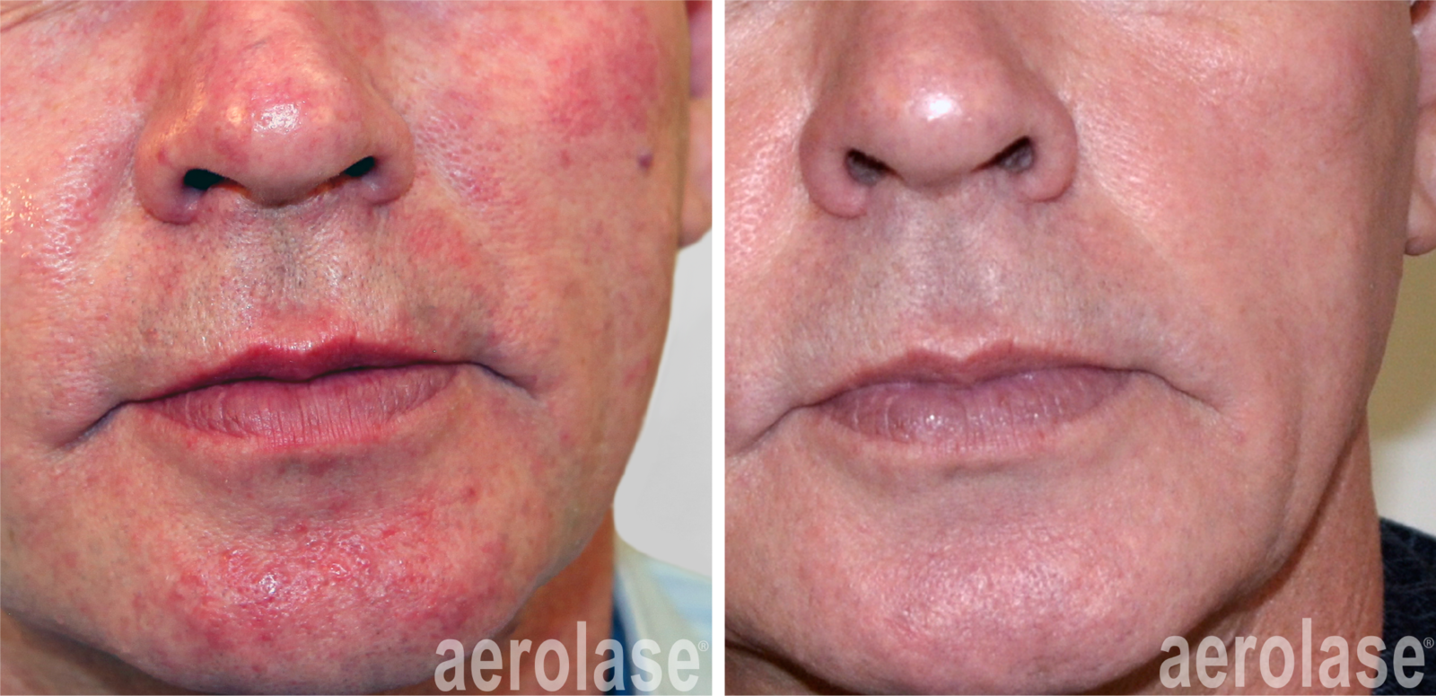 before and after rosacea and skin redness laser treatment