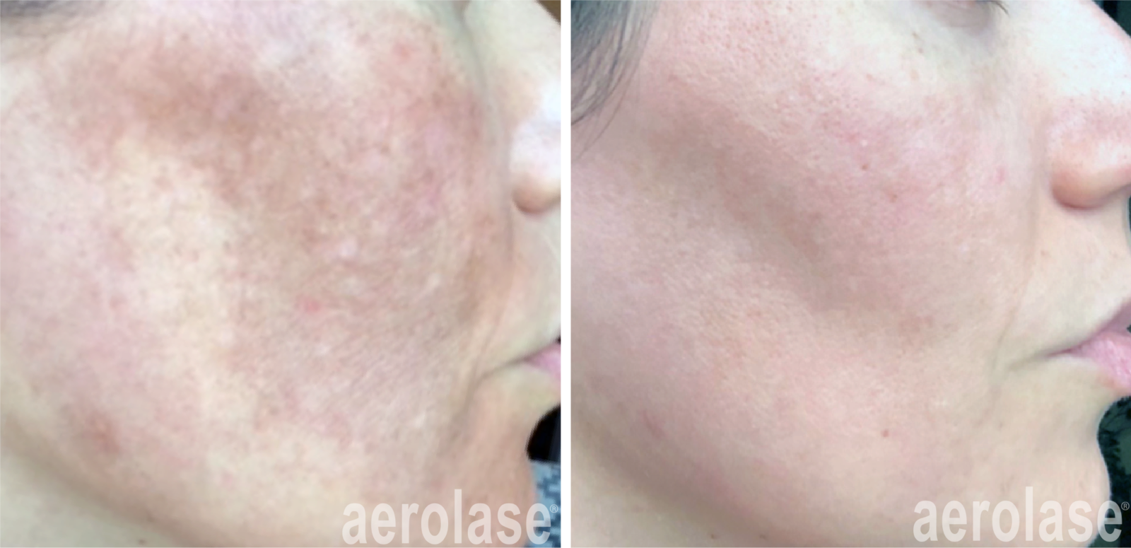 reducing melasma with aerolase laser skin resurfacing facial treatments