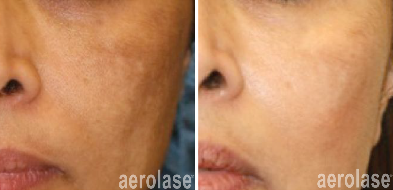 neoskin-melasma skin resurfacing treatment