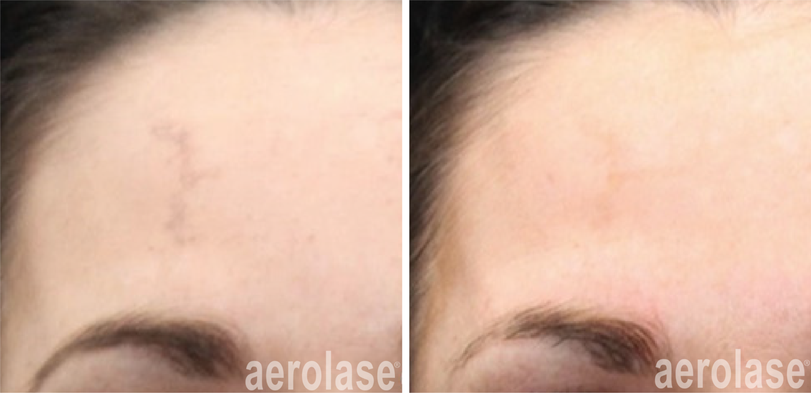 neoskin facial treatment with aerolase laser