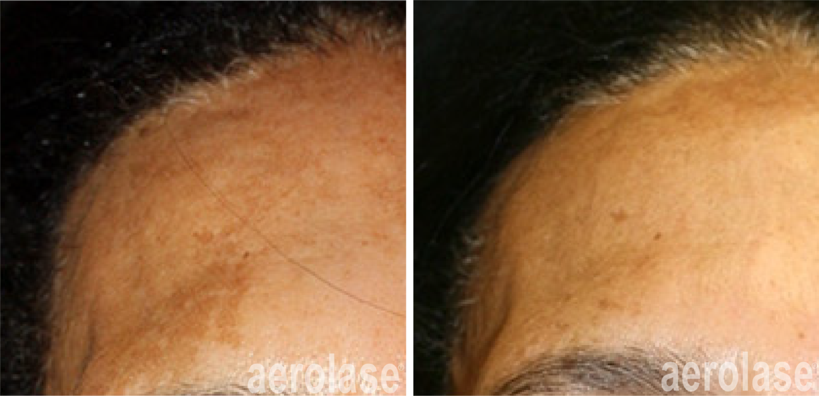 before and after laser treatment on facial skin
