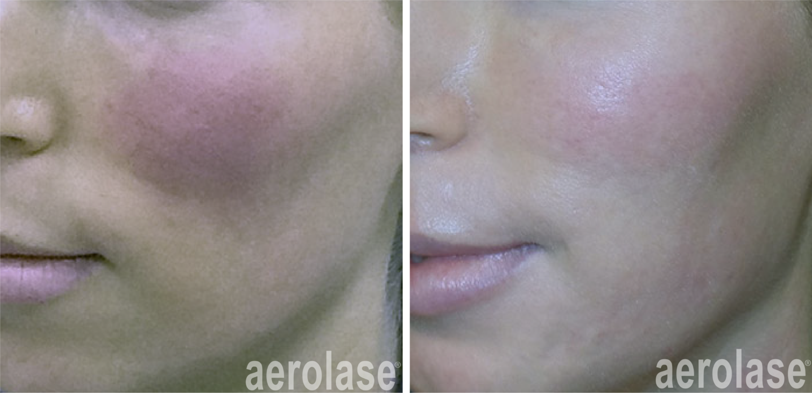 reducing skin redness with aerolase laser skin resurfacing and treatments