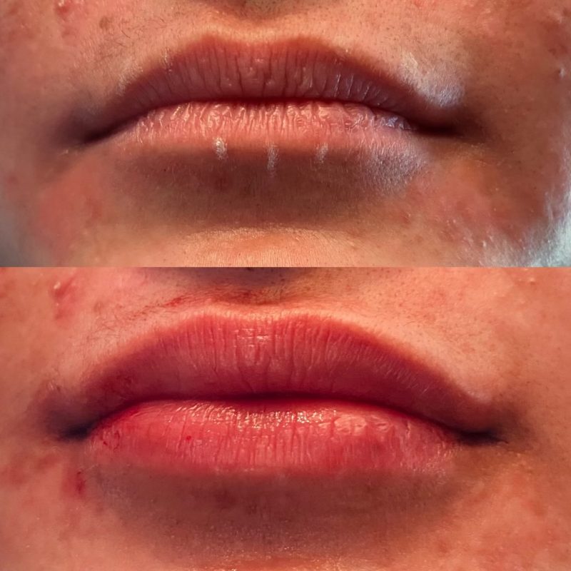 Lip Filler - Before & After