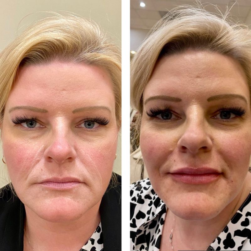 before and after cheek and lip fillers at med spa