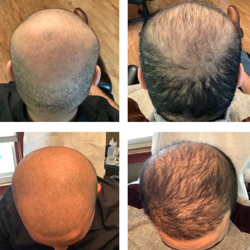 before and after professional balding treatment at lancaster med spa