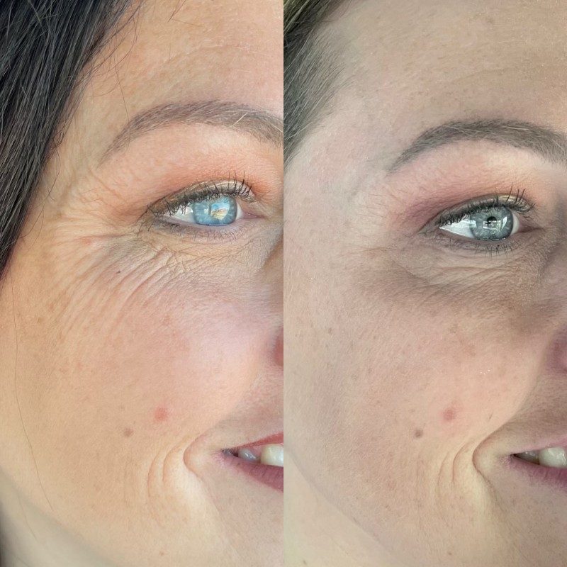 before and after botox for crows feet wrinkle lines
