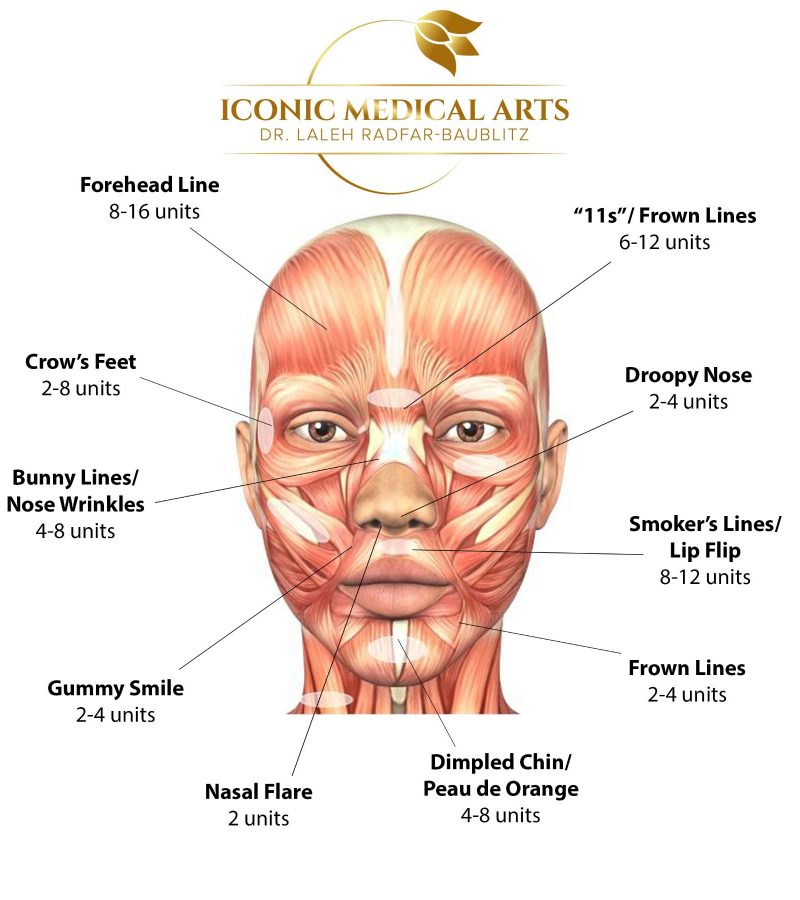chart of where botox and injectables can be used for various facial wrinkles and lines